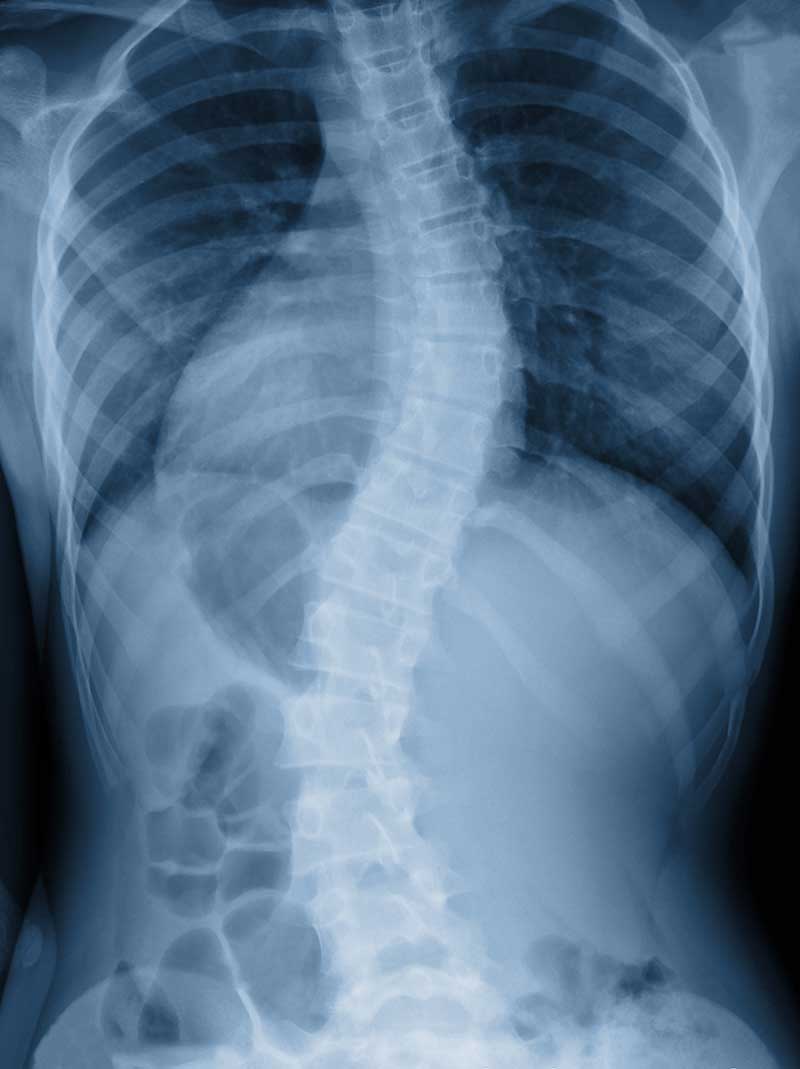 Scoliosis Humble, TX
